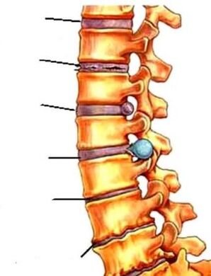 spinal osteochondritis