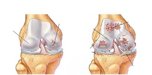 knee osteoarthritis deformity