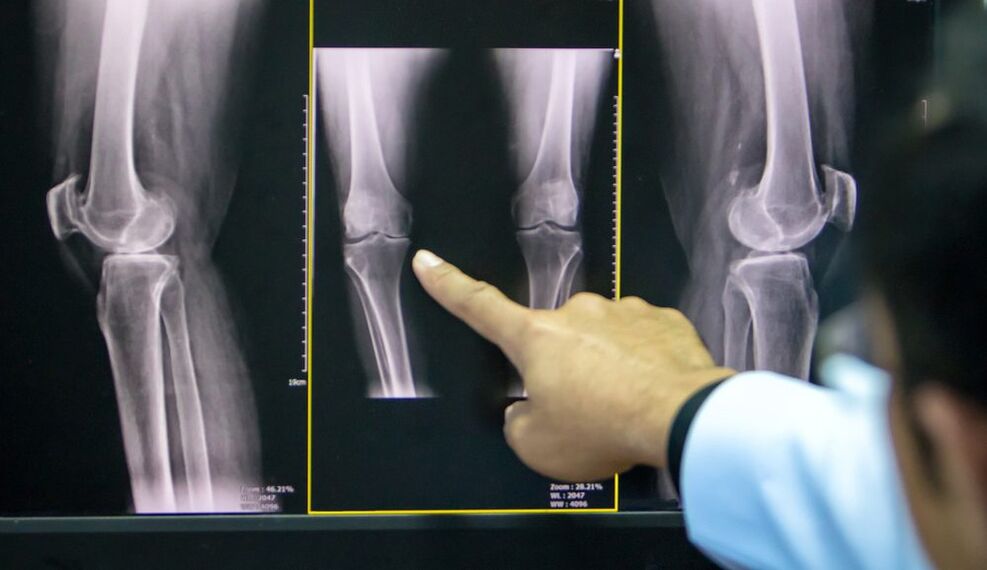 knee x-ray osteoarthritis