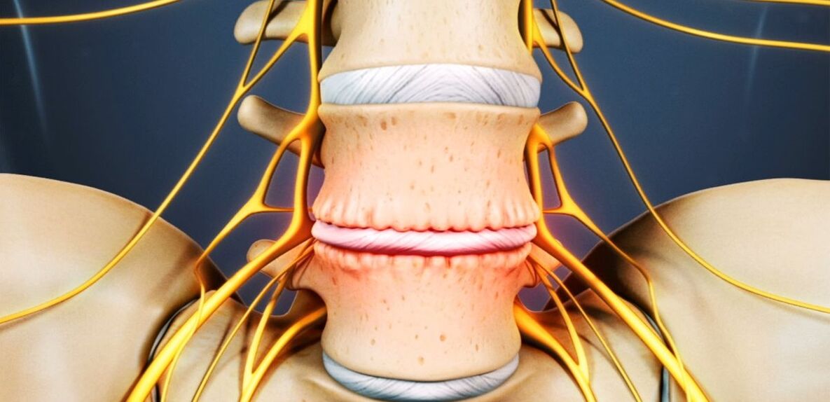 Lumbar spine osteochondrosis