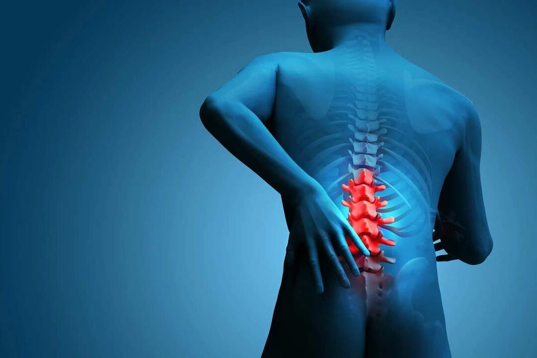 The main symptom of lumbar spine osteochondrosis is back pain. 