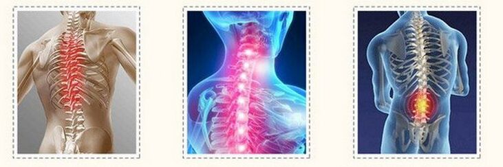 osteochondrosis of the different spine