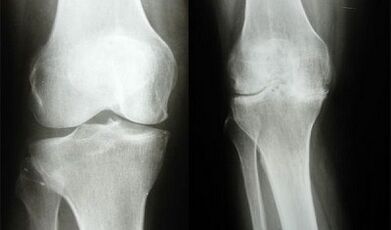 Knee diagnostic methods