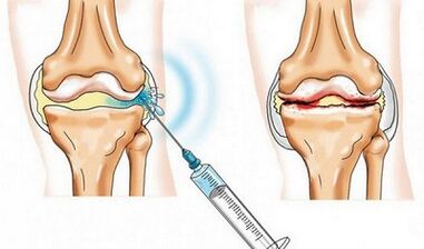 Knee joint blockade for arthrosis