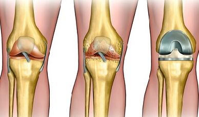 The degree of development of knee joint arthrosis