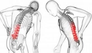 Intervertebral hernia - complication with osteochondrosis