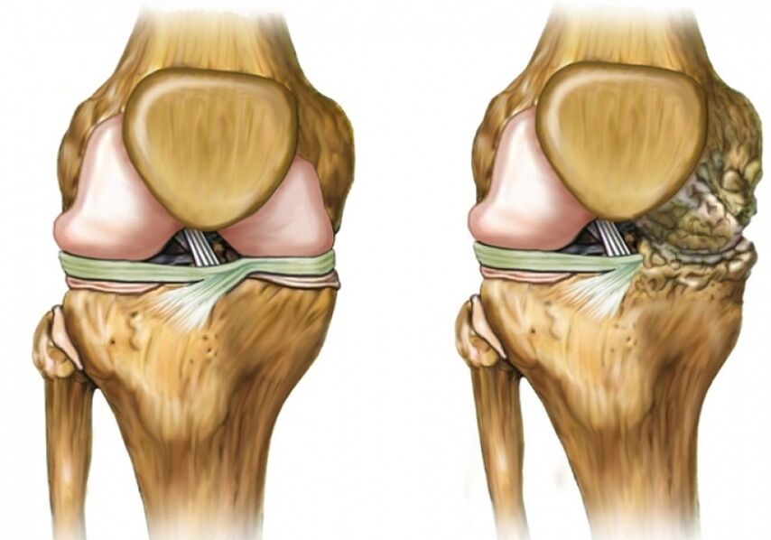 Arthritis