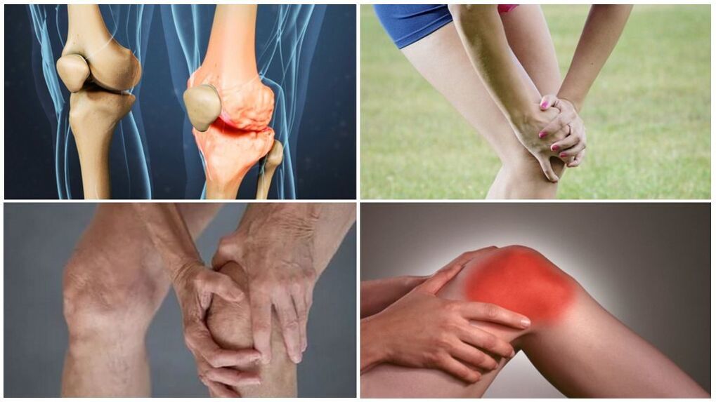 Stages of arthrosis