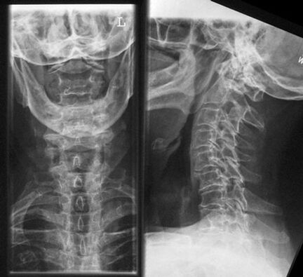 X -QEARRIZICS - Method of Diagnosis of Osteochondrosis