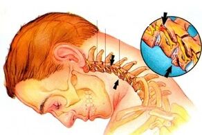 Pinching of the nerve in the spine with osteochondrosis of the cervical