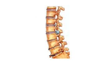 Spinal cord damage with osteochondrosis of the cervix