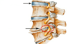 normal spine and damaged with cervical osteochondrosis