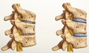 what does osteochondrosis look like