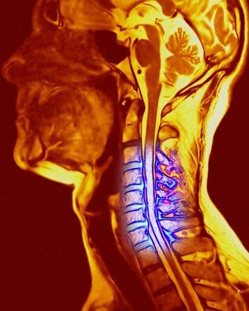 Cervical chondrosis